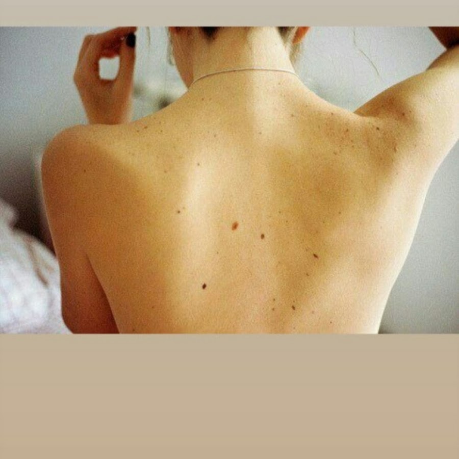 Веснушки на спине девушки