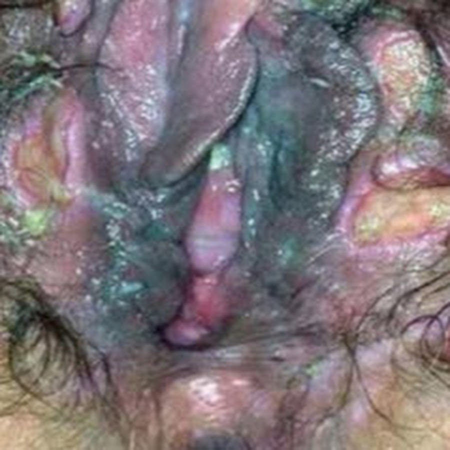 Blue Waffle.