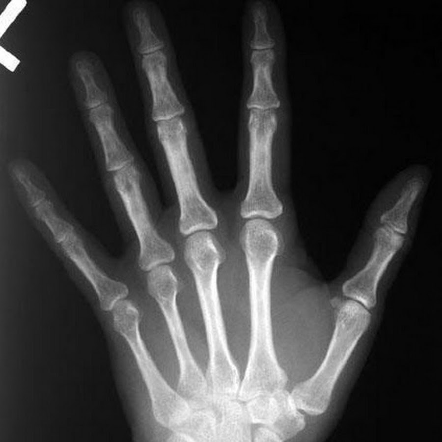 Лучезапястный сустав рентген анатомия