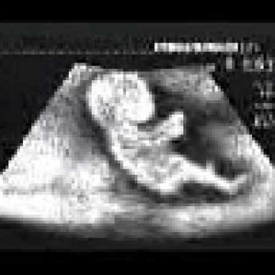 фото узи 31 недели