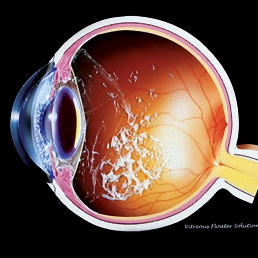 Помутнение стекловидного тела. Кольцо Вейса офтальмология. Стекловидное тело глаза. Грыжа стекловидного тела. Прозрачное тело в глазу
