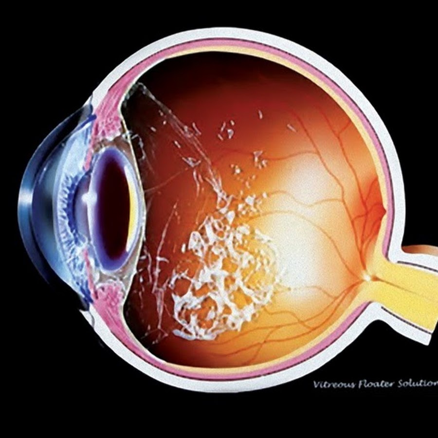Деструкция стекловидного тела капли. Помутнение стекловидного тела. Кольцо Вейса офтальмология. Грыжа стекловидного тела. Деструкция стекловидного тела.